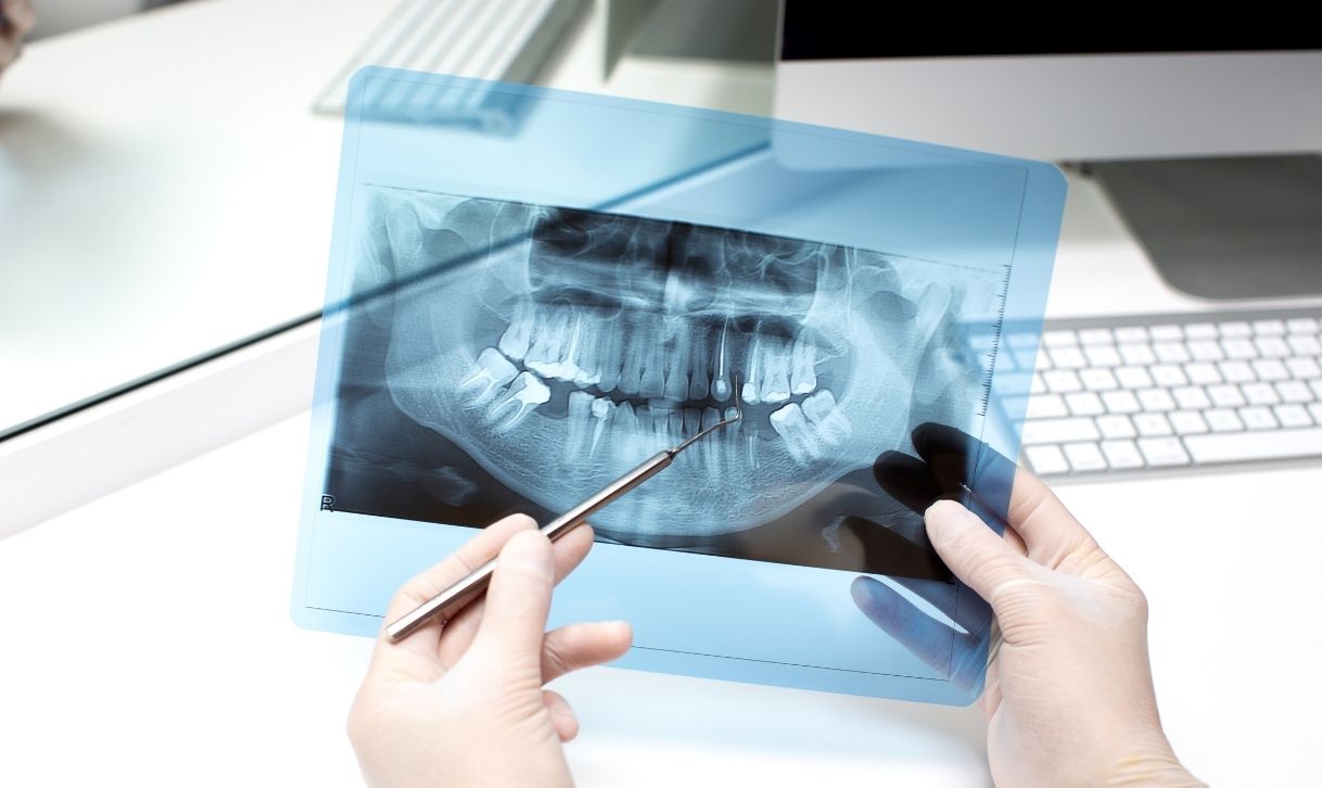 Tratamento Endodôntico